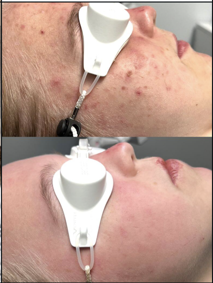 Before and after acne treatment result at VIBGYOR Skin Lab