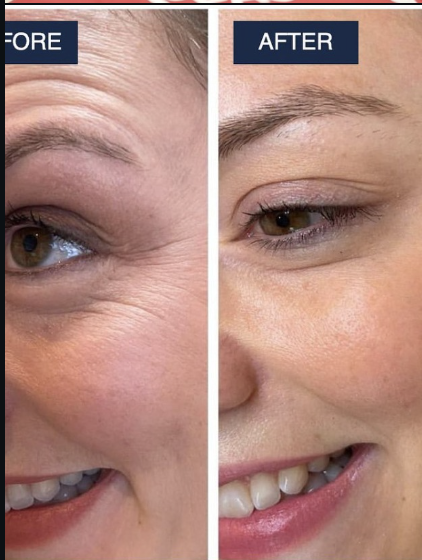Before and after fine lines treatment result at VIBGYOR Skin Lab
