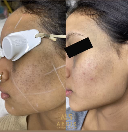 Before and after pigmentation treatment result at VIBGYOR Skin Lab