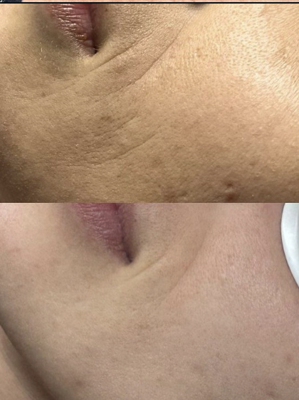 Before and after skin texture treatment result at VIBGYOR Skin Lab