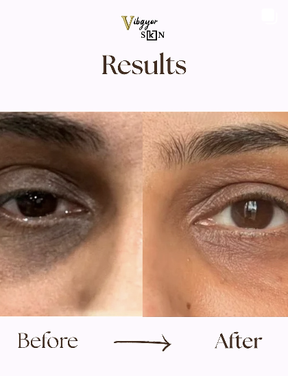 Before and after under-eye treatment result at VIBGYOR Skin Lab